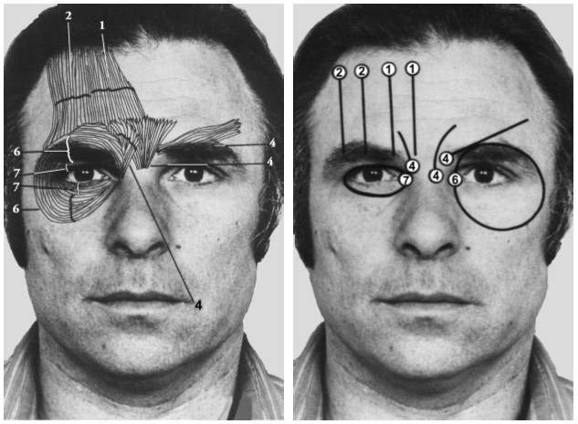 Figure 5B: Facial muscles moving eyebrow and muscles around the eye when expressing different emotions